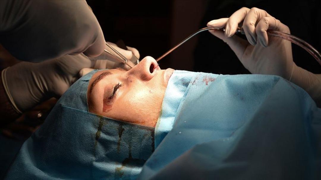 Bu tür estetik kişiselleştirilmelidir: burun estetik olmak isteyenler onlara dikkat eder! Uzmanlar: